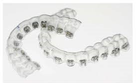 INDIRECT BONDING TRAY