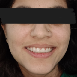 After image