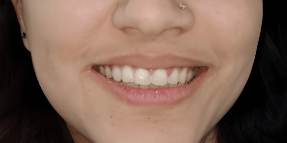 aferbefor1